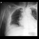 Serial rib fracture: X-ray - Plain radiograph